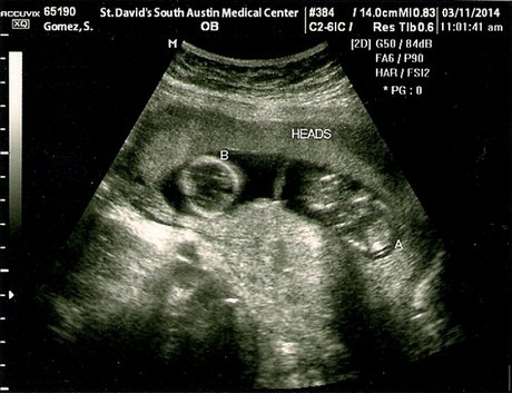 selena gomez ultrasound Najluđa glasina: Objavljeno da Selena čeka blizance sa Justinom!